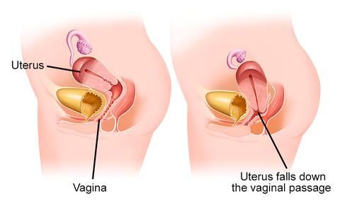 Prolapsed-uterus-illustration-3263ec_480x480